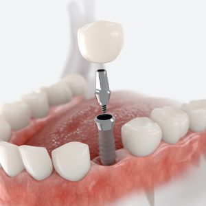 dental-implant